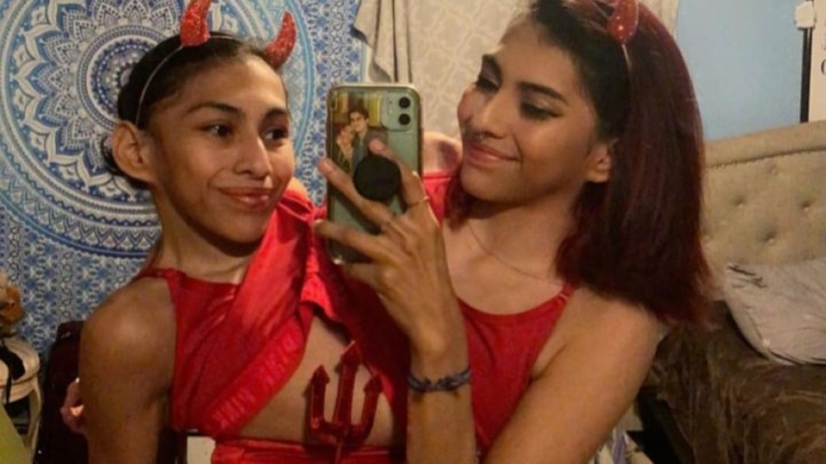 Parents of conjoined twins Carmen Lupita were told their daughters only
